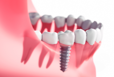 Dental Implants Okotoks