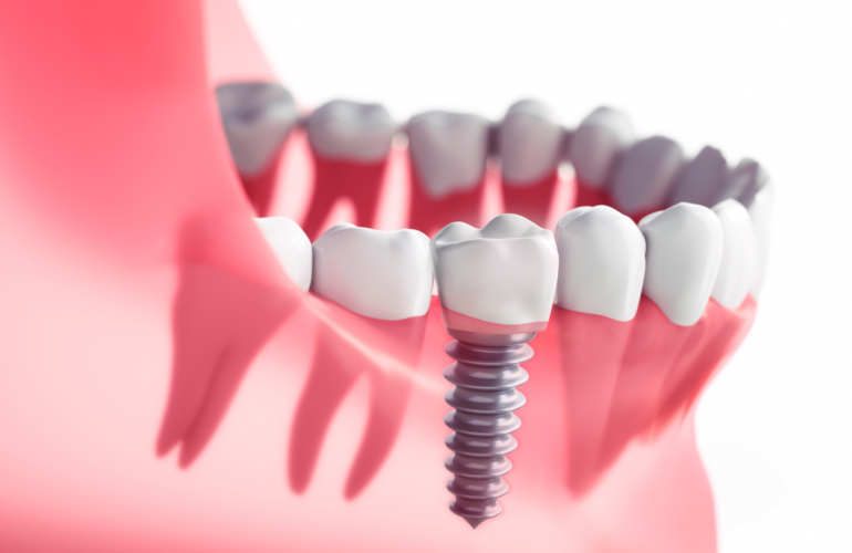 Dental-Implant