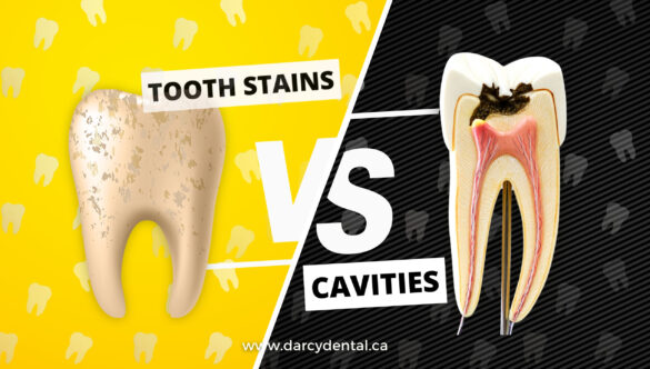 TOOTH STAINS VS. CAVITIES